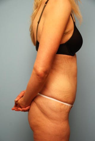 Tummy Tuck Before & After Gallery - Patient 277555 - Image 6