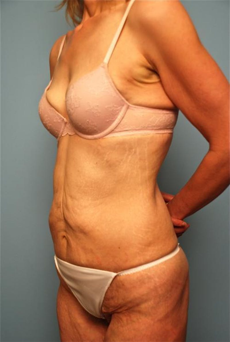 Tummy Tuck Before & After Gallery - Patient 277555 - Image 7