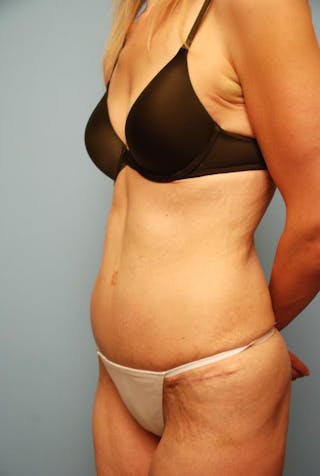 Tummy Tuck Before & After Gallery - Patient 277555 - Image 8