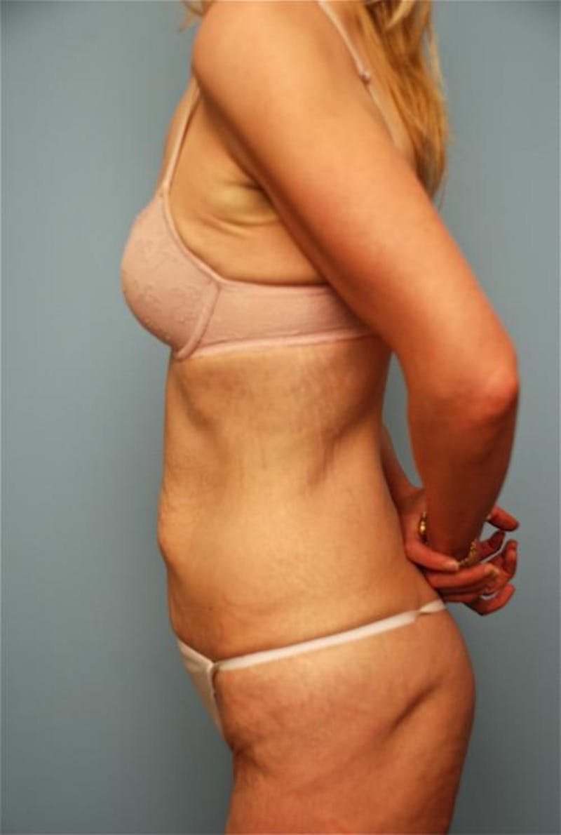 Tummy Tuck Before & After Gallery - Patient 277555 - Image 9
