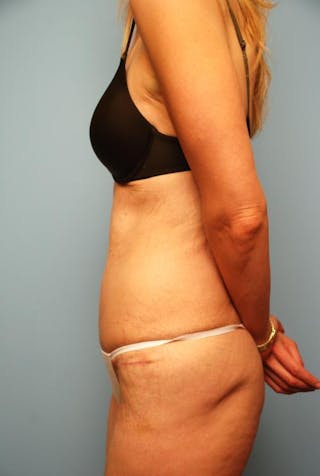 Tummy Tuck Before & After Gallery - Patient 277555 - Image 10