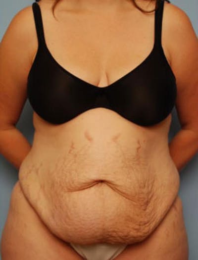 Tummy Tuck Before & After Gallery - Patient 718539 - Image 1