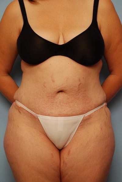 Tummy Tuck Before & After Gallery - Patient 718539 - Image 2