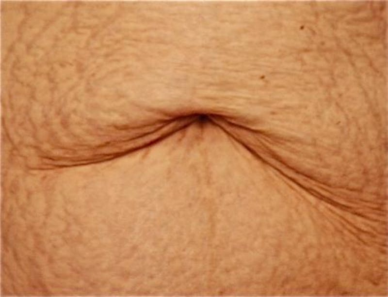 Tummy Tuck Before & After Gallery - Patient 421057 - Image 11