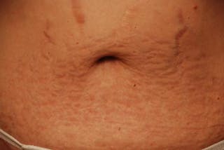 Tummy Tuck Before & After Gallery - Patient 421057 - Image 12