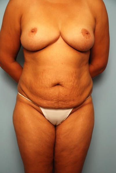 Tummy Tuck Before & After Gallery - Patient 103293 - Image 1