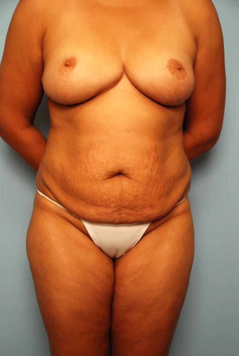 Liposuction Before & After Gallery - Patient 115888 - Image 1