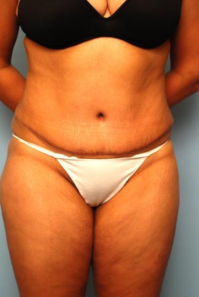 Tummy Tuck Before & After Gallery - Patient 103293 - Image 2