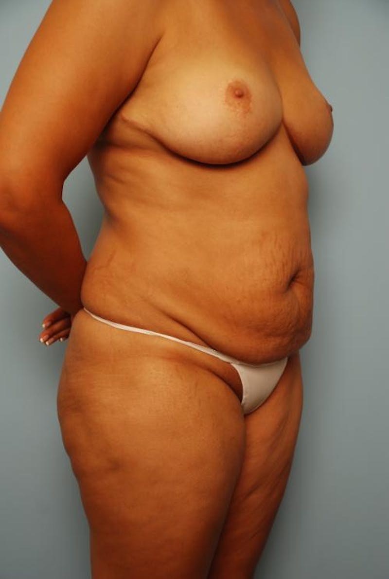 Liposuction Before & After Gallery - Patient 115888 - Image 3
