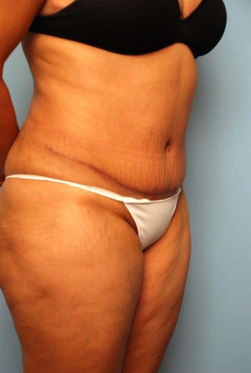 Liposuction Before & After Gallery - Patient 115888 - Image 4
