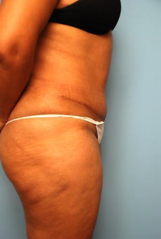 Liposuction Before & After Gallery - Patient 115888 - Image 6