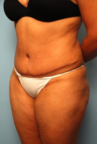 Liposuction Before & After Gallery - Patient 115888 - Image 8