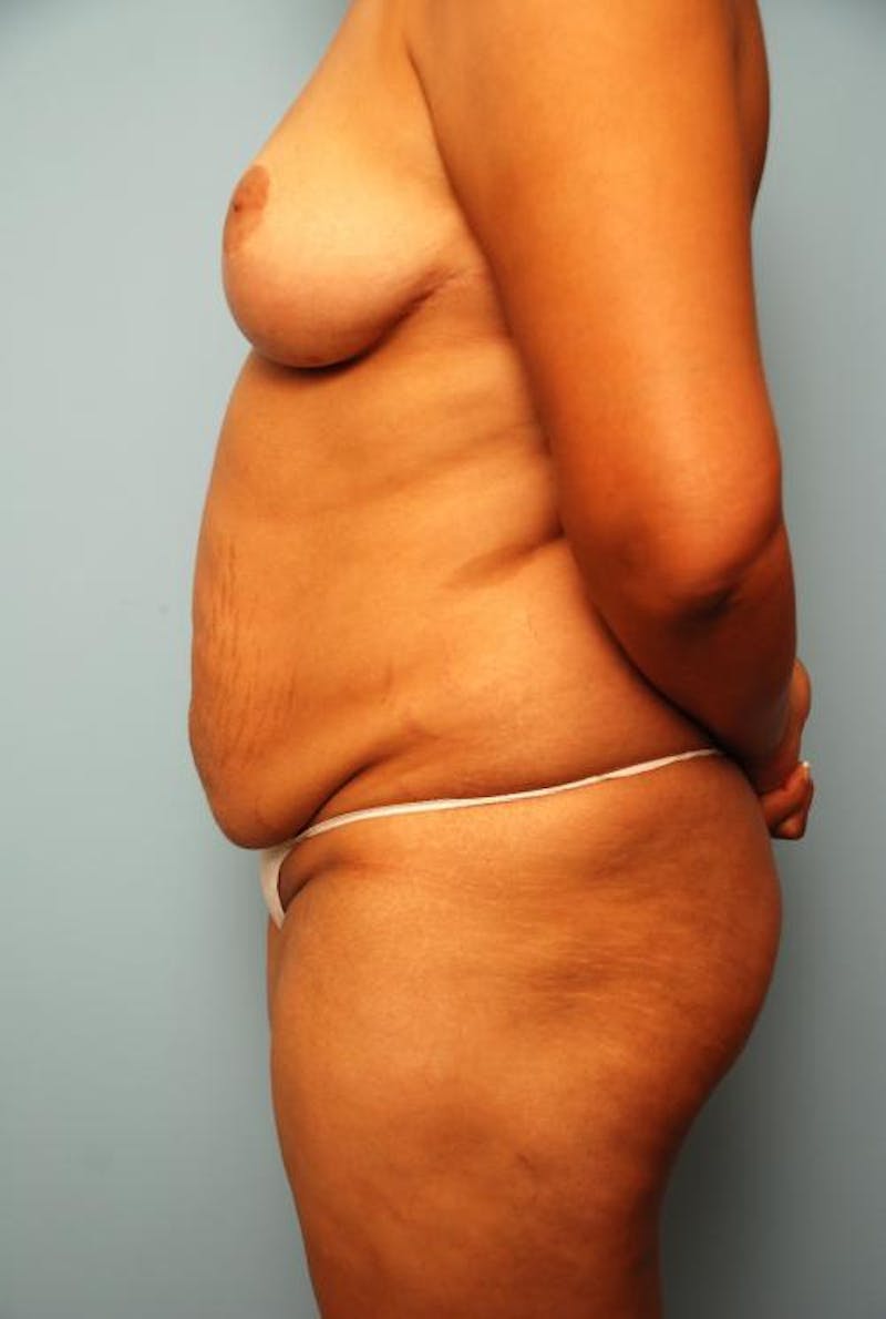 Liposuction Before & After Gallery - Patient 115888 - Image 9