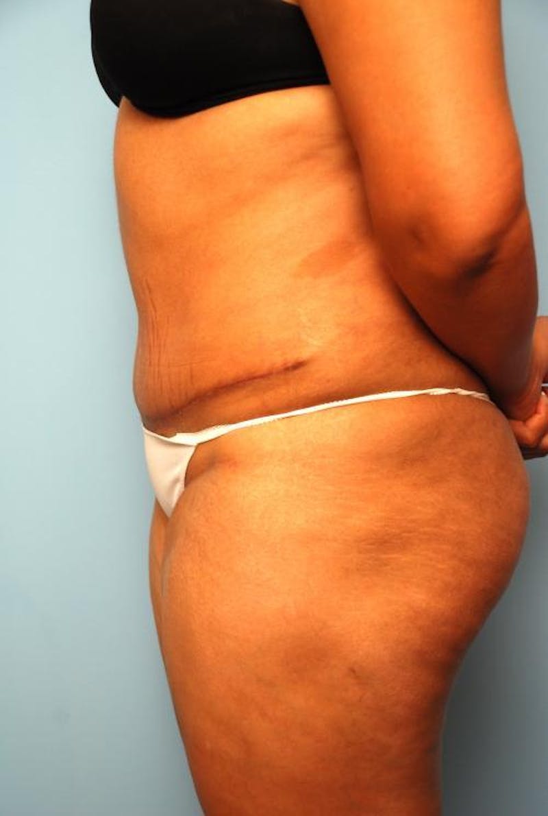 Liposuction Before & After Gallery - Patient 115888 - Image 10
