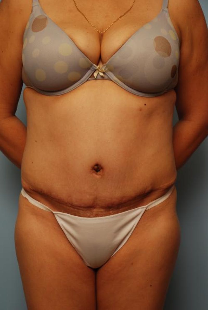 Tummy Tuck Before & After Gallery - Patient 160842 - Image 2