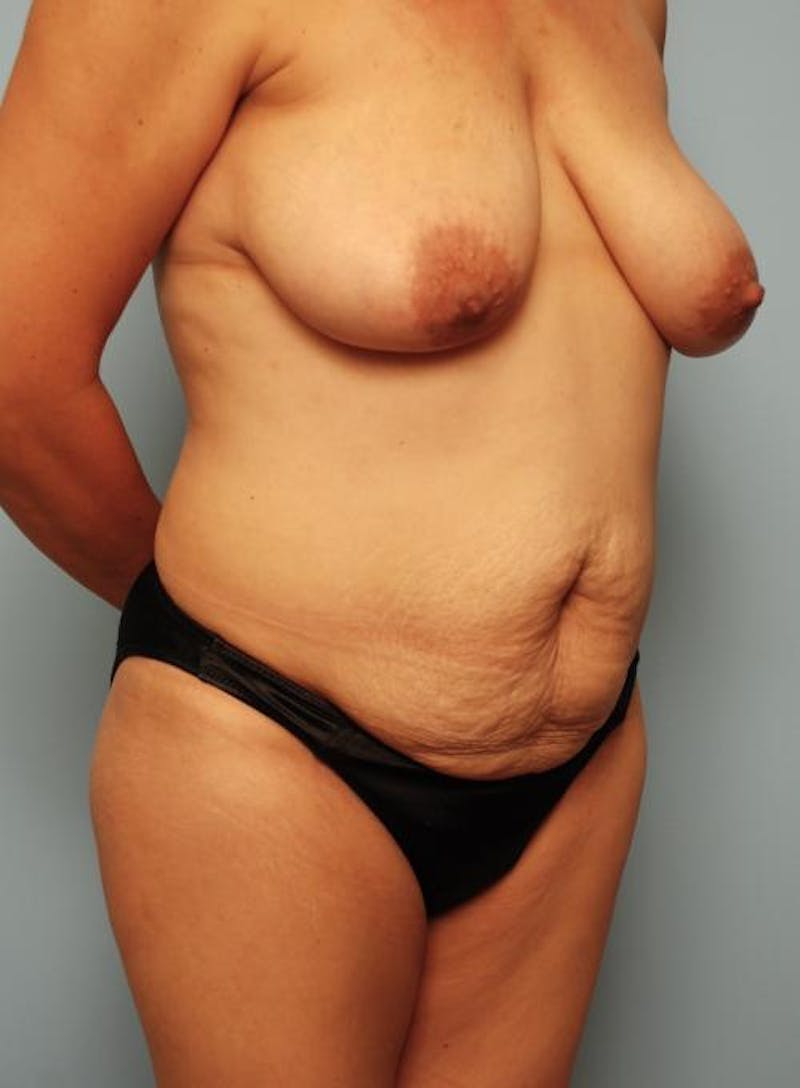 Tummy Tuck Before & After Gallery - Patient 160842 - Image 3