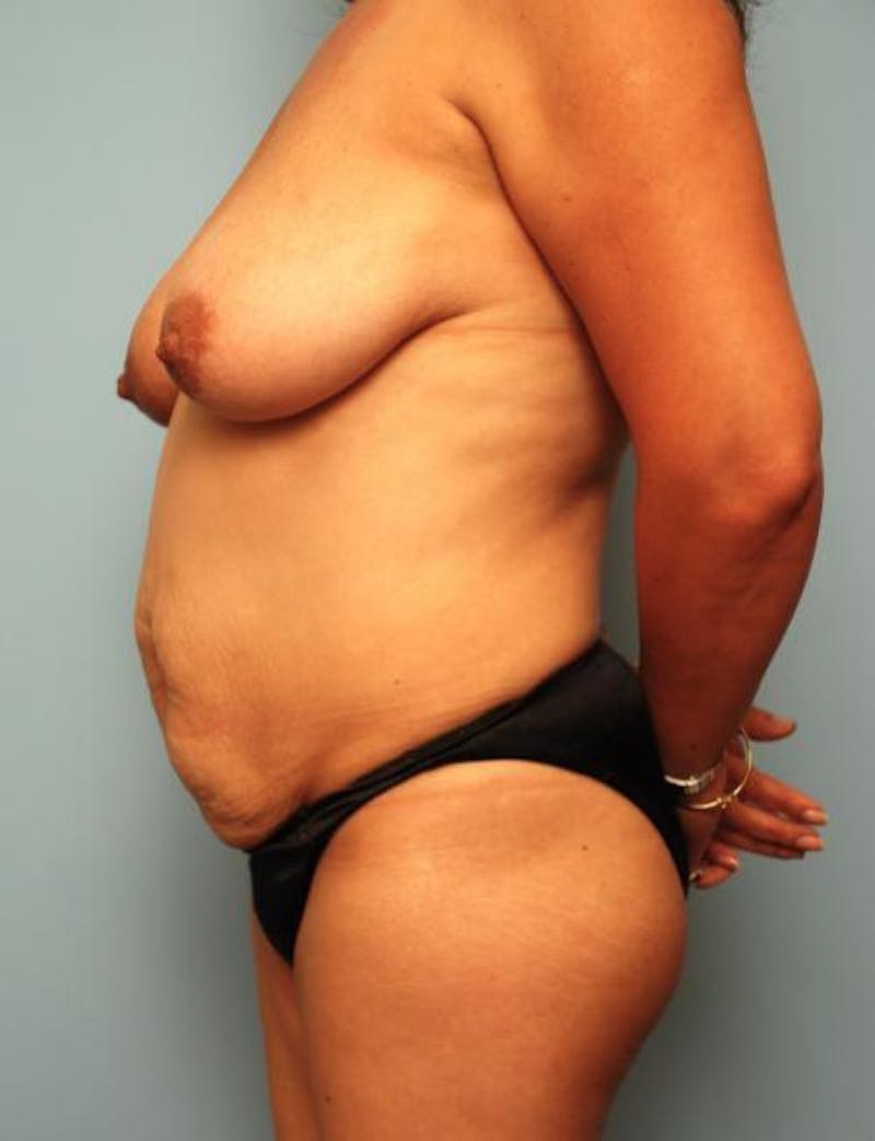 Tummy Tuck Before & After Gallery - Patient 160842 - Image 9
