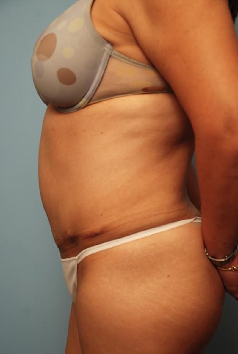 Tummy Tuck Before & After Gallery - Patient 160842 - Image 10