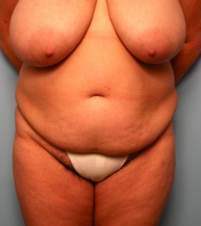 Tummy Tuck Before & After Gallery - Patient 265999 - Image 1