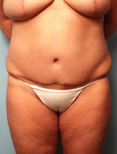 Tummy Tuck Before & After Gallery - Patient 265999 - Image 2