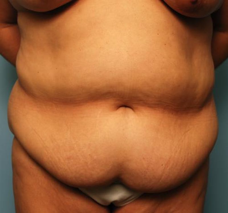 Tummy Tuck Before & After Gallery - Patient 386041 - Image 1