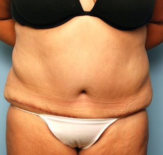 Tummy Tuck Before & After Gallery - Patient 386041 - Image 2