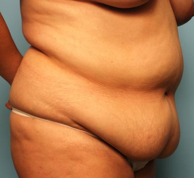 Tummy Tuck Before & After Gallery - Patient 386041 - Image 3