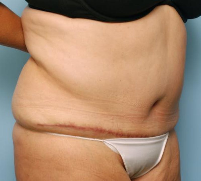 Tummy Tuck Before & After Gallery - Patient 386041 - Image 4