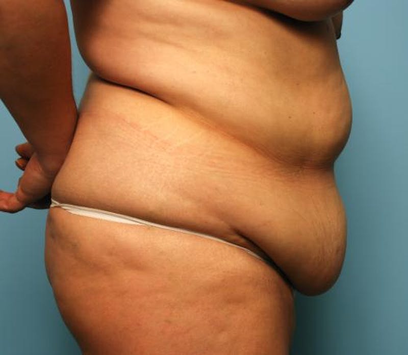 Tummy Tuck Before & After Gallery - Patient 386041 - Image 5