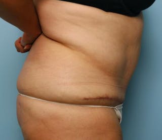 Tummy Tuck Before & After Gallery - Patient 386041 - Image 6