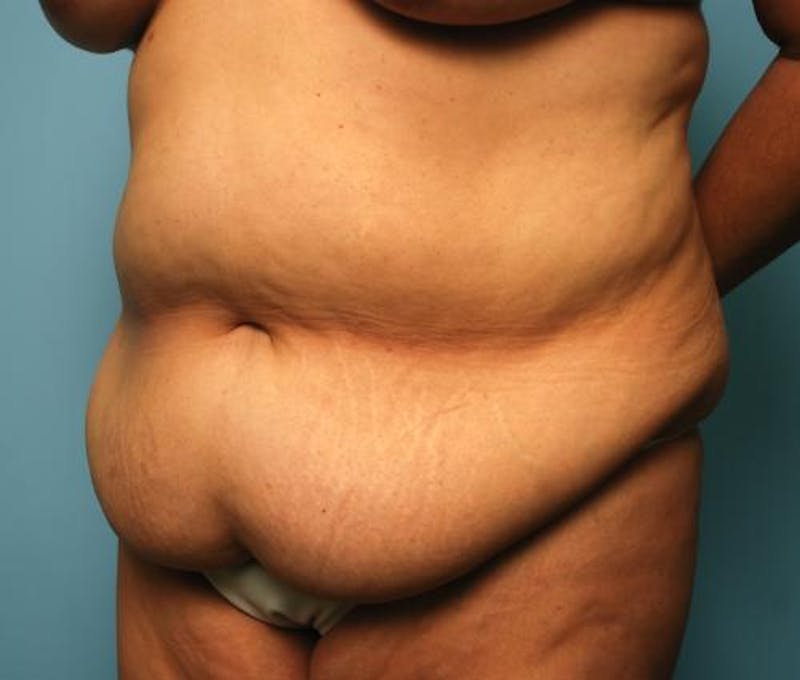 Tummy Tuck Before & After Gallery - Patient 386041 - Image 7