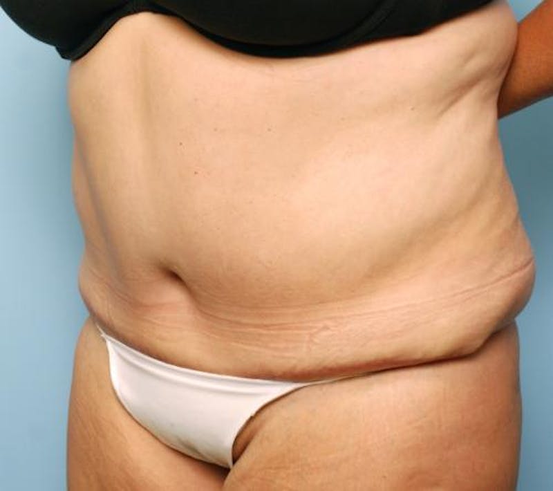 Tummy Tuck Before & After Gallery - Patient 386041 - Image 8
