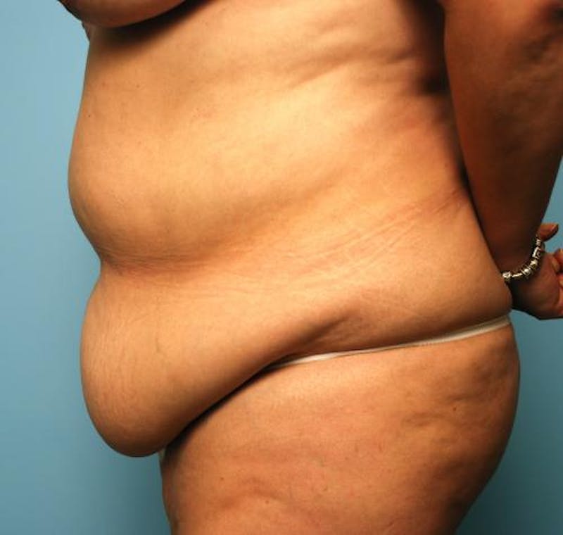 Tummy Tuck Before & After Gallery - Patient 386041 - Image 9
