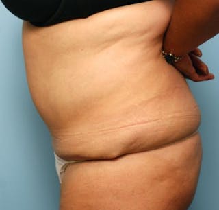 Tummy Tuck Before & After Gallery - Patient 386041 - Image 10
