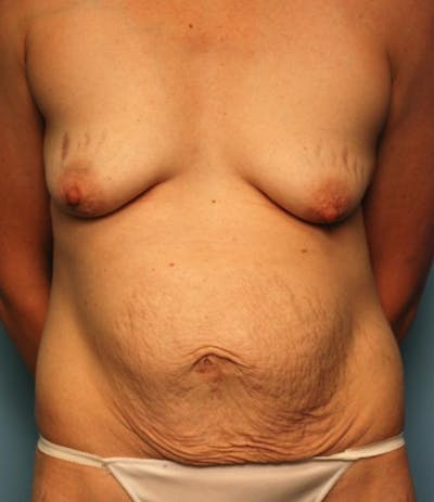 Tummy Tuck Before & After Gallery - Patient 214426 - Image 1