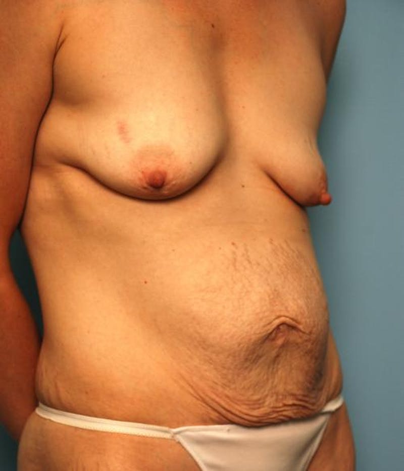 Tummy Tuck Before & After Gallery - Patient 299767 - Image 3