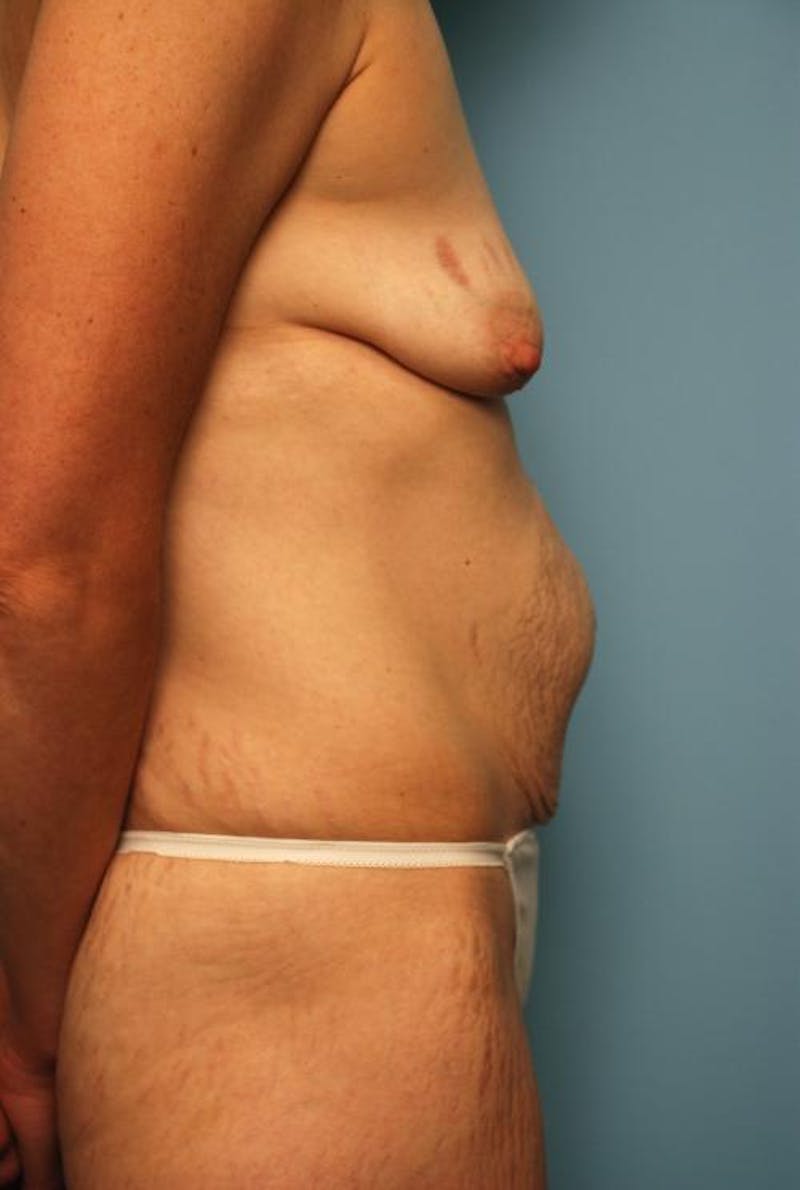 Tummy Tuck Before & After Gallery - Patient 299767 - Image 5