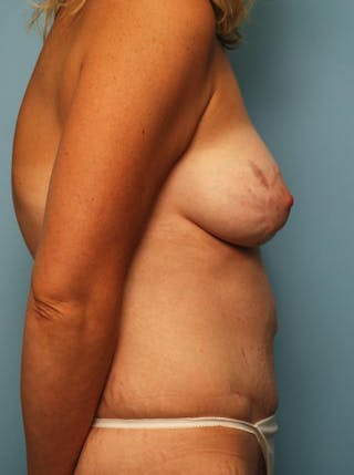 Tummy Tuck Before & After Gallery - Patient 299767 - Image 6