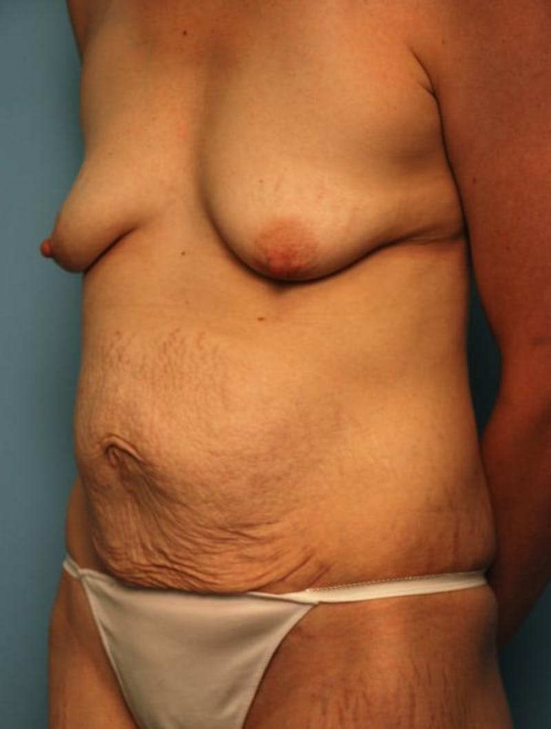 Tummy Tuck Before & After Gallery - Patient 299767 - Image 7