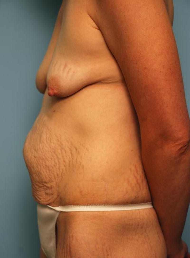 Tummy Tuck Before & After Gallery - Patient 299767 - Image 9