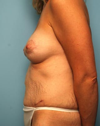 Tummy Tuck Before & After Gallery - Patient 299767 - Image 10