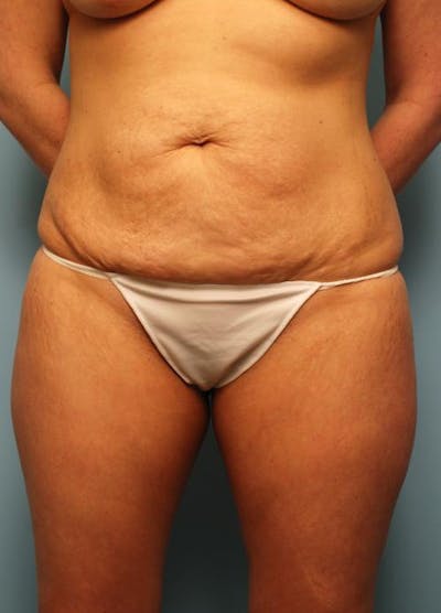 Tummy Tuck Before & After Gallery - Patient 175698 - Image 1