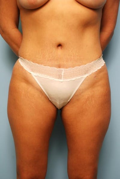Tummy Tuck Before & After Gallery - Patient 175698 - Image 2