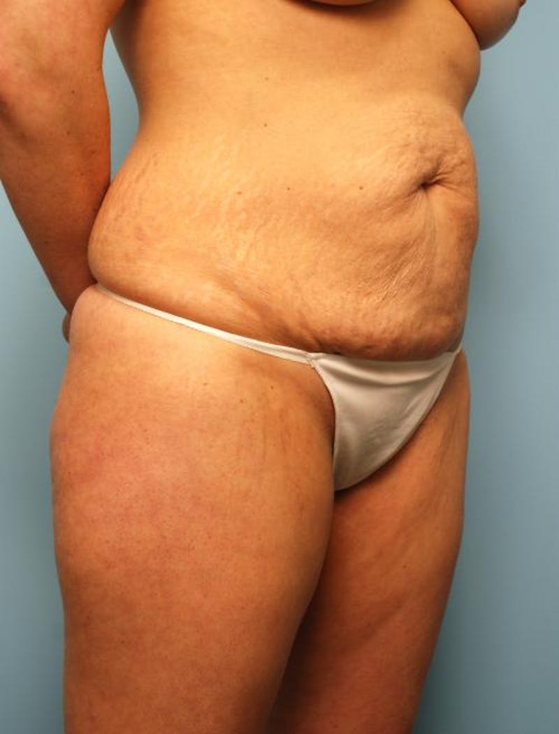 Liposuction Before & After Gallery - Patient 142670 - Image 3