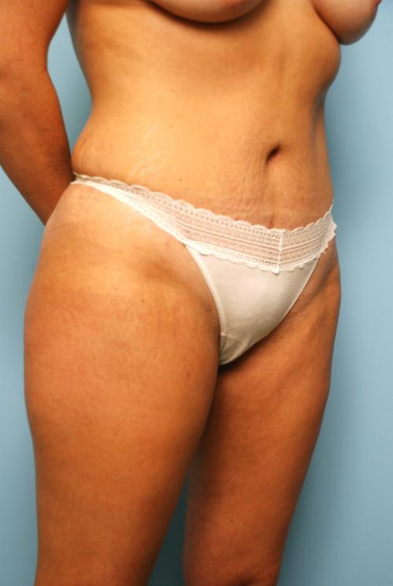 Liposuction Before & After Gallery - Patient 142670 - Image 4