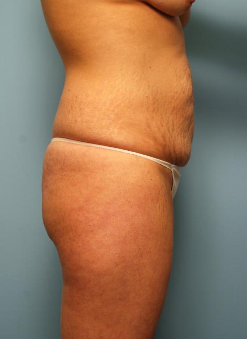Liposuction Before & After Gallery - Patient 142670 - Image 5