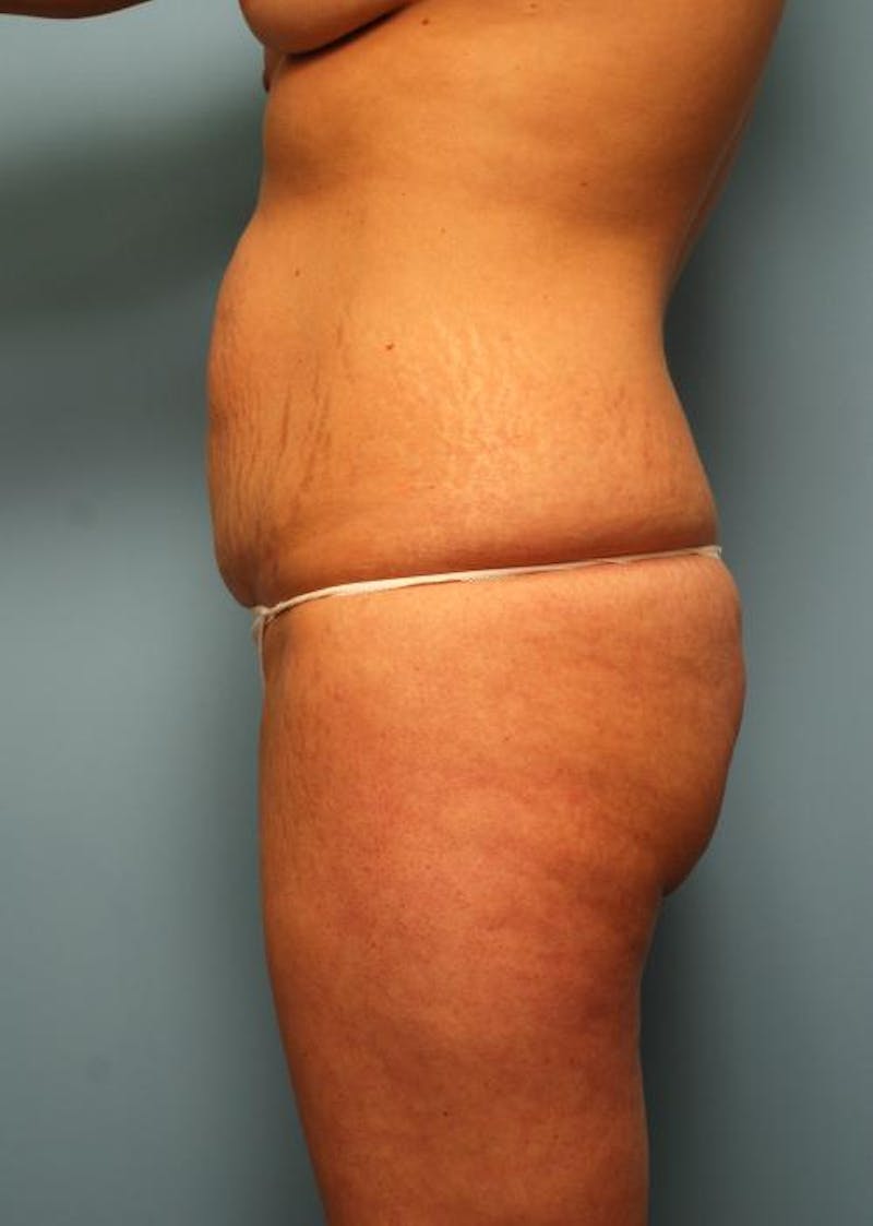 Liposuction Before & After Gallery - Patient 142670 - Image 9