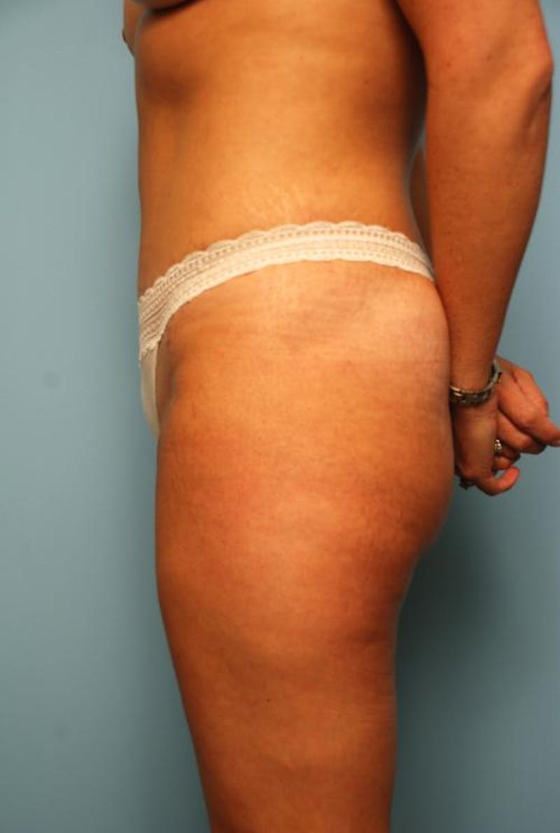 Liposuction Before & After Gallery - Patient 142670 - Image 10
