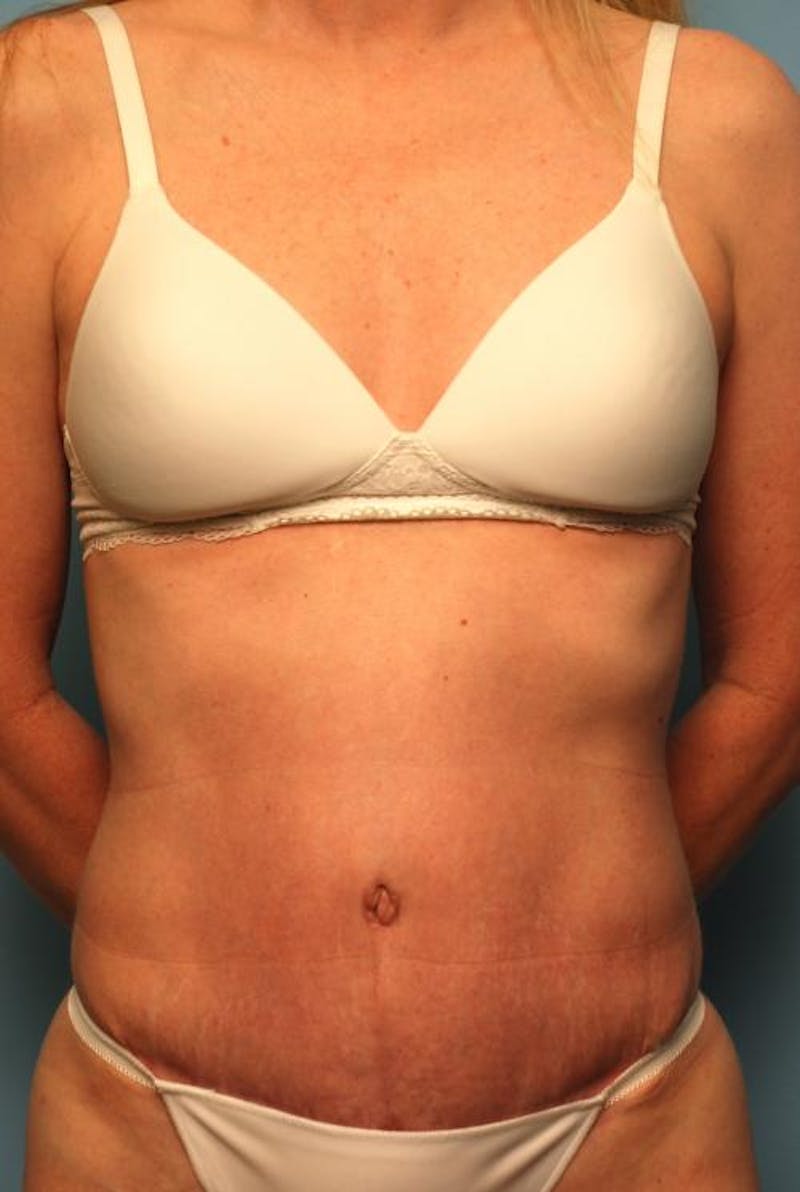 Tummy Tuck Before & After Gallery - Patient 494956 - Image 2