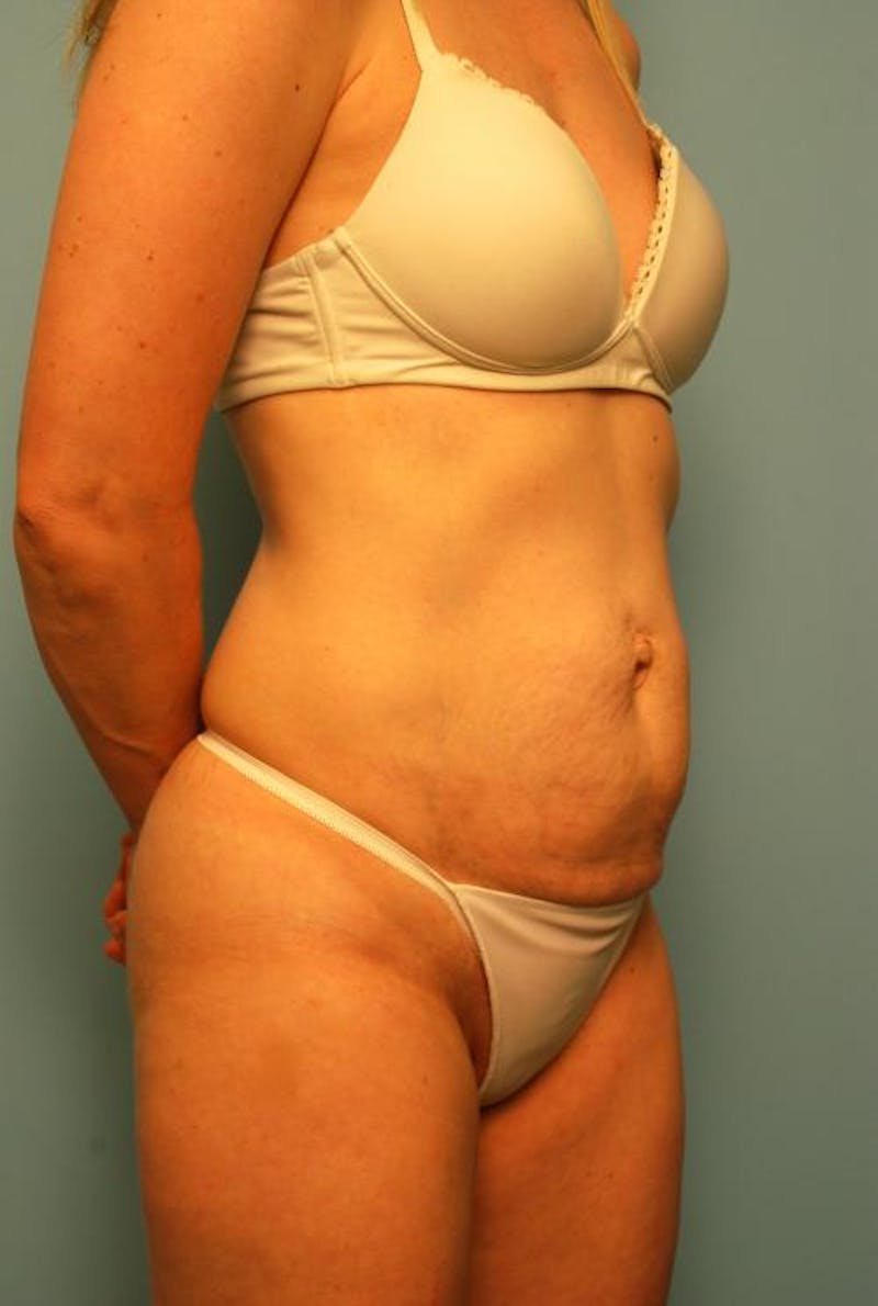 Tummy Tuck Before & After Gallery - Patient 494956 - Image 3
